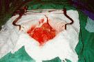 http://www.bibliomed.com.br/BancoImagens/Imagens/tmbAneurisma-da-aorta-abdomina.jpg