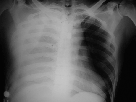 http://www.bibliomed.com.br/BancoImagens/Imagens/tmbRaio-X-de-torax---Derrame-pleural-direito.gif                 