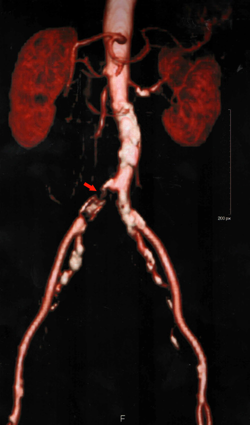 http://www.bibliomed.com.br/BancoImagens/Imagens/tmbangiotomografia-aorta.jpg