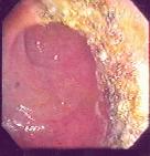 http://www.bibliomed.com.br/BancoImagens/Imagens/tmbapos-resseccao-de-tumor-veloso-reto.jpg