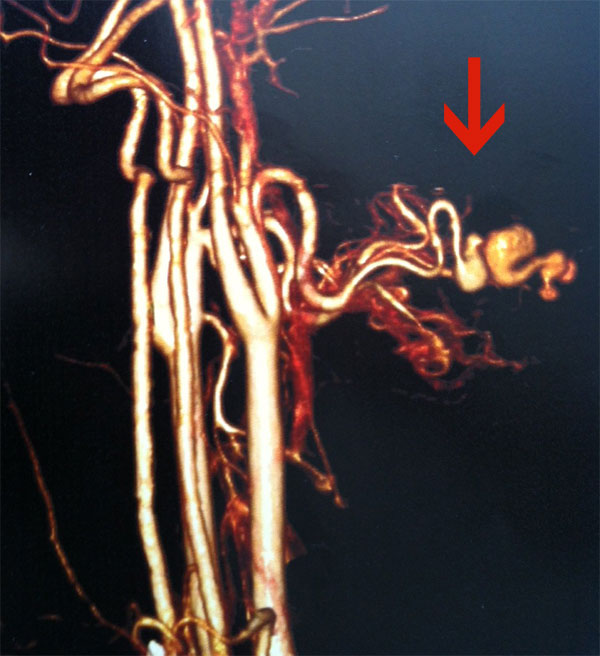 http://www.bibliomed.com.br/BancoImagens/Imagens/tmbfistula-arteriovenosa.jpg