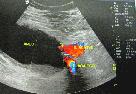 http://www.bibliomed.com.br/BancoImagens/Imagens/tmbimg_Aneurisma-da-aorta-abdominal-_-Duplex-scan-da-aorta-abdominal---corte-longitudinal-ao-nivel-da-bifurcação-da-aorta.jpg
