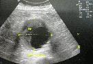 http://www.bibliomed.com.br/BancoImagens/Imagens/tmbimg_Aneurisma-da-aorta-abdominal-_-Duplex-scan-da-aorta-abdominal-com-grande-trombo-em-seu-interior-(TB)-_-corte-transversal.jpg