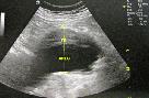 http://www.bibliomed.com.br/BancoImagens/Imagens/tmbimg_Aneurisma-da-aorta-abdominal-_-Duplex-scan-da-aorta-abdominal-com-trombo-em-seu-interior-(TB)---corte-longitudinal.jpg