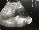 http://www.bibliomed.com.br/BancoImagens/Imagens/tmbimg_Aneurisma-da-aorta-abdominal-_-Duplex-scan-da-aorta.jpg