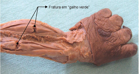 Fratura em “galho verde” provocada nos ossos do antebraço de um cadáver de criança