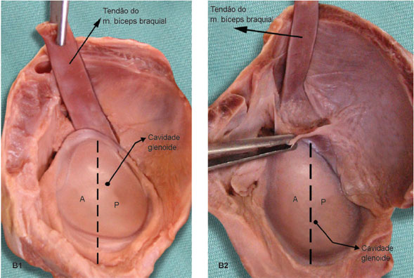 Em nove peças anatômicas, a inserção ocorreu exclusivamente no tubérculo supraglenoidal