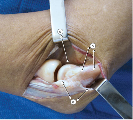 A incisão pode ser ampliada proximalmente