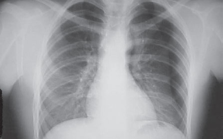 Radiografia de tórax em PA evidenciando ﻿de tórax em PA evidenciando pneumotórax à esquerda