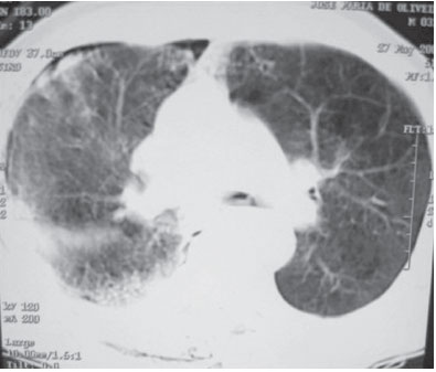 Tomografia de tórax evidencian﻿do contusão pulmonar à direita e pequeno pneumotórax