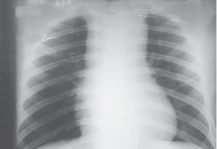 Radiografia de tórax mostrando alargamento de mediastino após trauma contuso