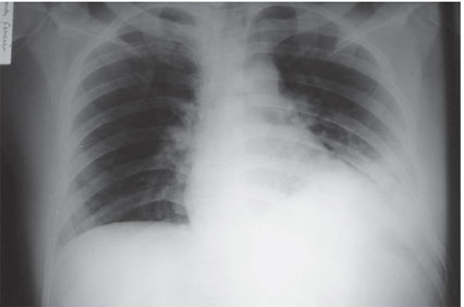 Radiografia de tórax evidenciando hemotórax retido à esquerda