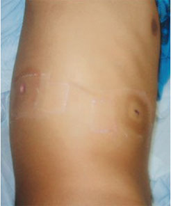 Orifícios de entrada e saída de ﻿projétil de arma de fogo, em transição ﻿tóraco abdominal à direita