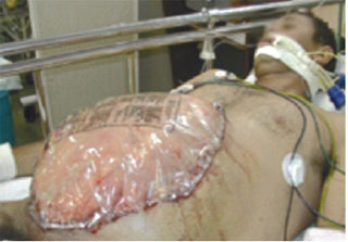 Laparostomia com fechamento alternativo ﻿após cirurgia para controle do dano