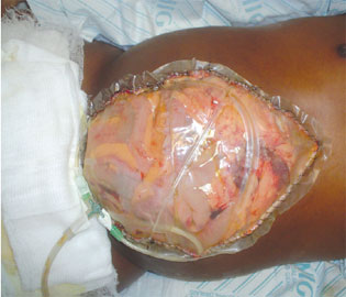 Laparostomia com fechamento alternativo para manejo da síndrome de compartimento