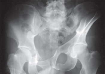 Radiografia de pelve demonstrando fratura pélvica complexa