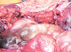 Lesão de cólon grau V, por trauma abdominal contuso