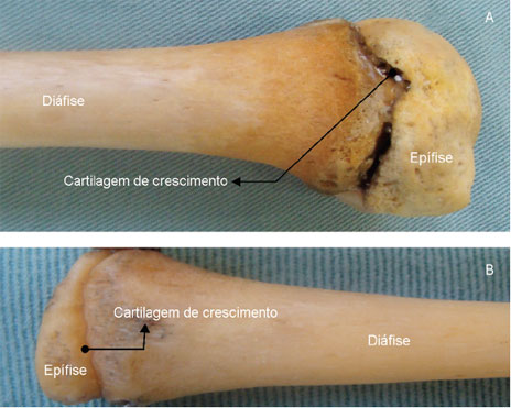 Cartilagem de crescimento