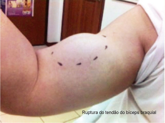 Ruptura do tendão do bíceps braquial na sua origem