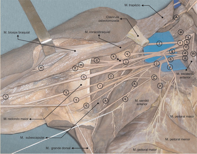 Dissecção anatômica mostrando todos os nervos que se originam do plexo braquial