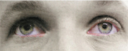 Sinal de Claude- Bernard-Horner à esquerda