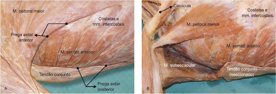 Prega axilar anterior, constituída pela borda lateral do m. peitoral maior