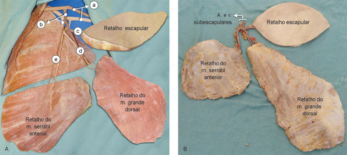 O retalho da região escapular pode ser associado aos retalhos do m. serrátil e do m. grande dorsal