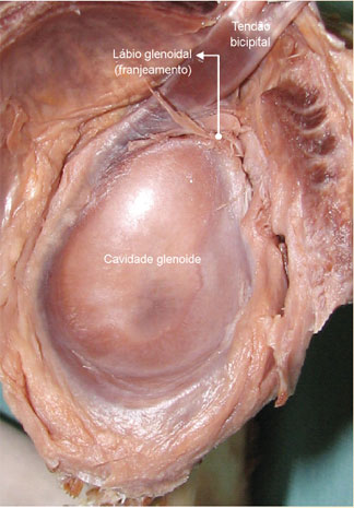 Lesão SLAP tipo I na parte superior do lábio glenoidal