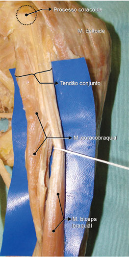 O m. coracobraquial origina-se do processo coracoide da escápula