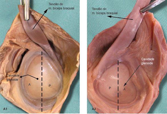 Em quatro peças anatômicas, a inserção ocorreu exclusivamente no lábio glenoidal