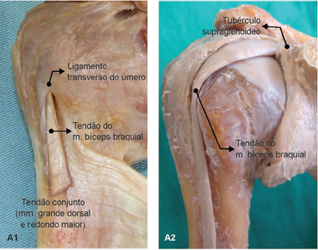 O ligamento transverso do úmero une os tubérculos maior e menor