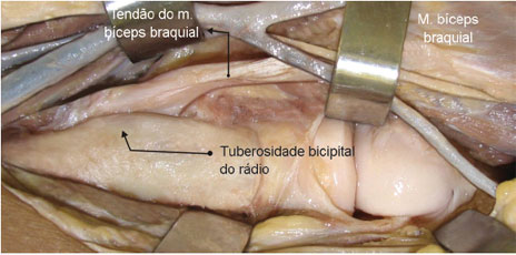 Inserção distal do tendão do m. bíceps braquial