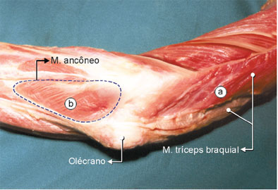 Dissecção em cotovelo de cadáver fresco mostrando os músculos da região posterior do antebraço