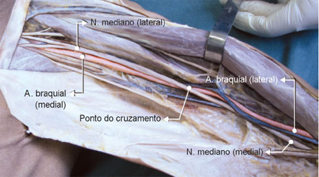 Na região proximal do braço