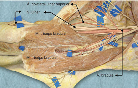 O n. ulnar no braço acompanha a a. colateral ulnar superior