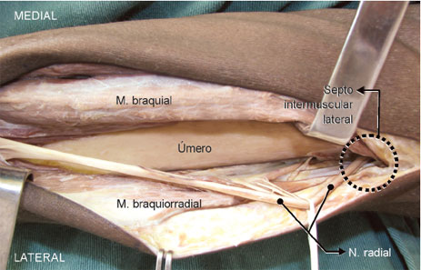 Vista anterior. Após passagem pelo seu sulco, o n. radial passa pelo septo intermuscular lateral