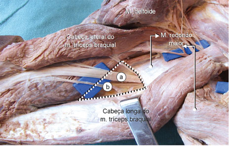 Vista posterior. N. radial 