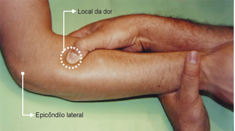 Na síndrome do túnel radial