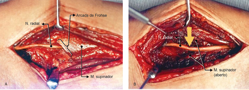 Caso clínico de compressão do n. interósseo posterior na arcada de Frohse