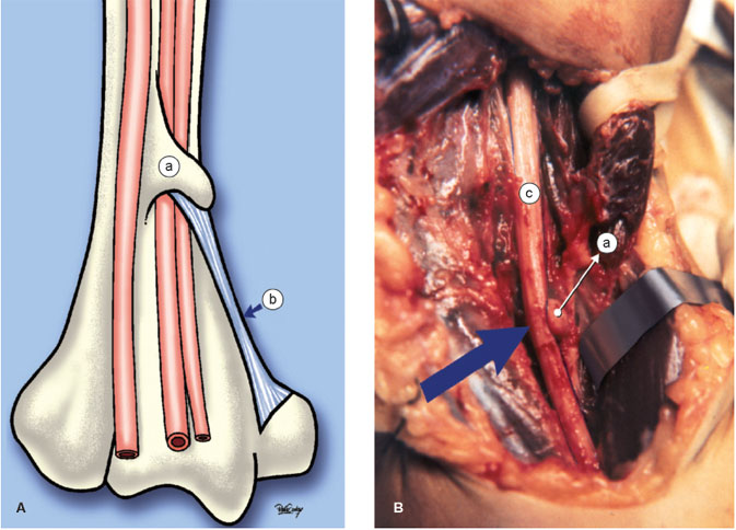 Processo supracondilar do úmero