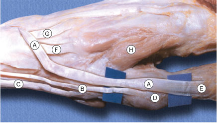 Variação anatômica no trajeto do tendão do m. extensor longo do polegar
