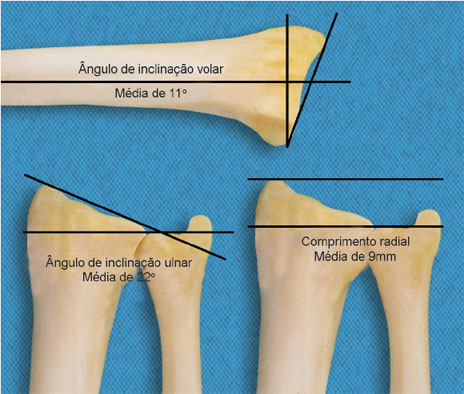 Na posição de perfil existe uma inclinação palmar da superfície articular
