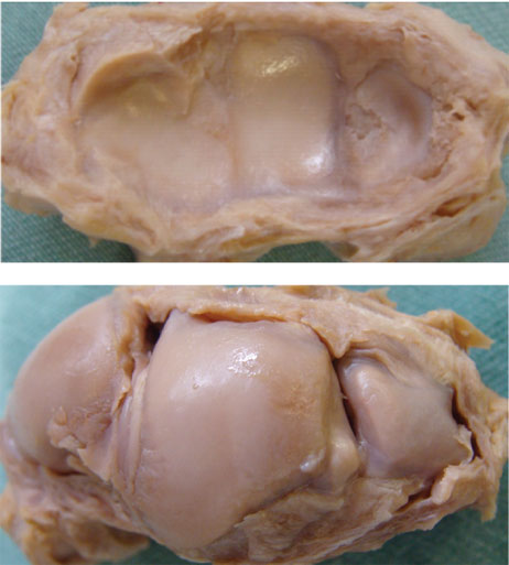 Perfuração da fibrocartilagem triangular