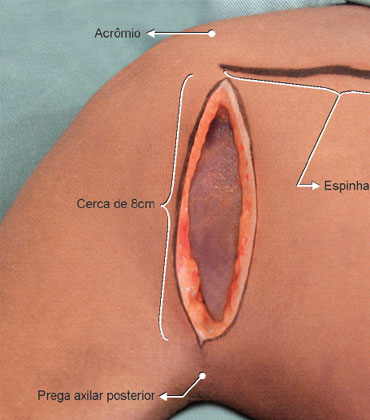 A incisão, medindo cerca de 8cm