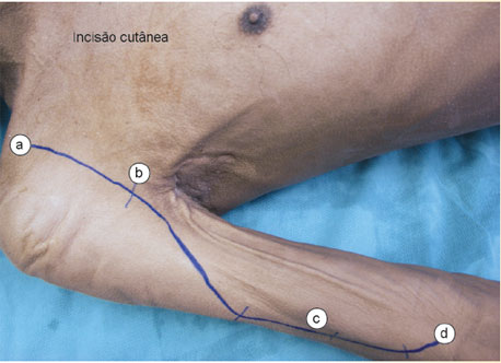 A incisão inicia-se no processo coracoide da escápula