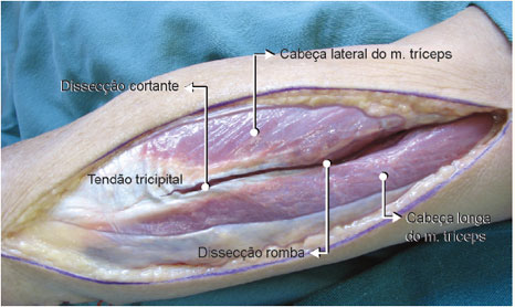 A dissecção na região proximal das cabeças lateral
