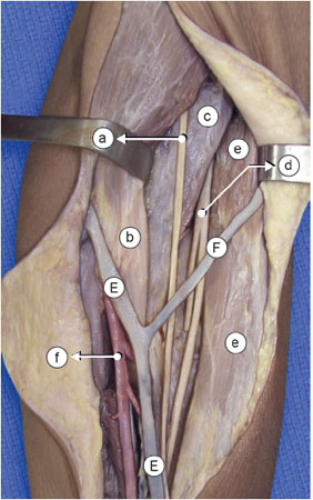 Identifica-se o n. cutâneo lateral do antebraço 