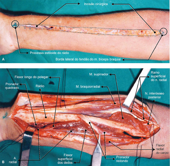 Via de acesso anterolateral do antebraço