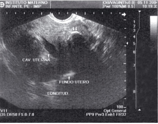 Mioma intramural com calcificação semicircular. 
