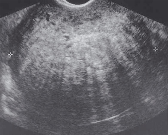 Adenomiose – útero com volume aumentado, parede posterior alargada difusamente. 